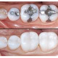 Color Stability Natural Dental Inlays And Onlays With Abrasion Resistance For Teeth